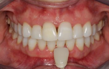 enlighten-tooth-whitening-after