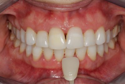 Enlighten Tooth Whitening After