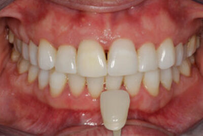 Enlighten Tooth Whitening After