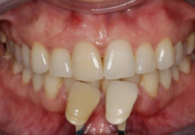Enlighten Tooth Whitening Before
