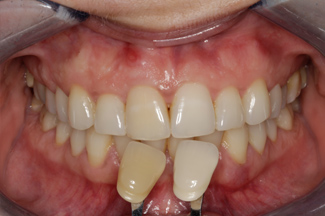 Enlighten tooth whitening