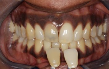 enlighten-tooth-whitening-dentist-before