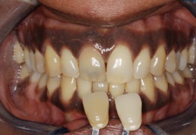 Enlighten Tooth Whitening Before