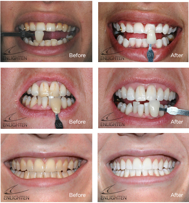 Enlighten Tooth Whitening Before and After