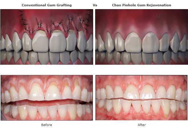 Receding Gums Before and After