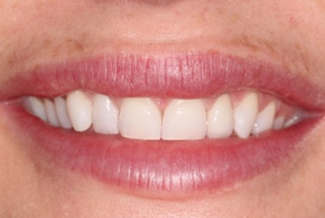 Gingival Recontouring After