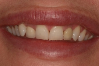 Gingival Recontouring Before