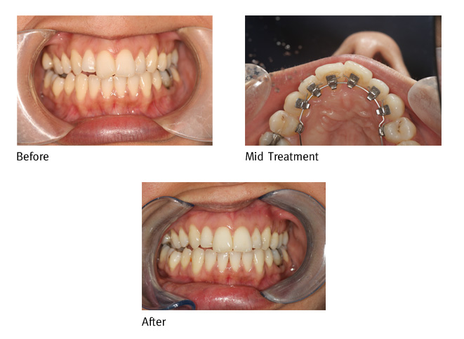 Before and After Incognito braces