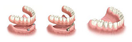 Restoration in the dental implants
