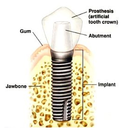 Surgical Stents