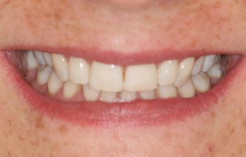 inman_aligner_london_after