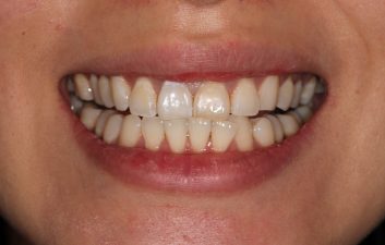 Internal tooth bleaching after