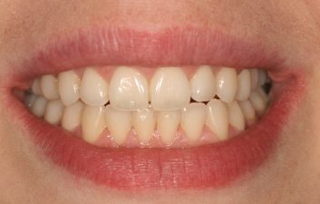 Invisalign_braces_london_after 