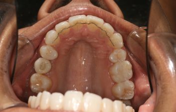 invisalign-dentist-london-after