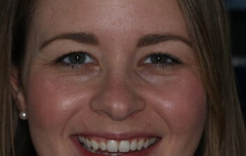 Invisalign local finchley dentist after