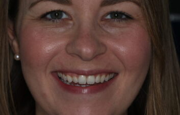 Invisalign local finchley dentist after
