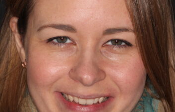 Invisalign local finchley dentist before