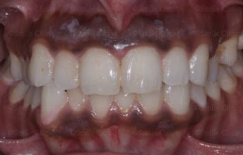 Before gum laser depigmentation