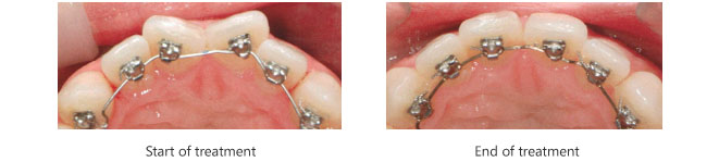 Start and end of lingual treatment