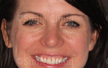 Before Veneers