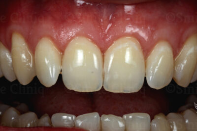 London dentist receeding gums treatment after