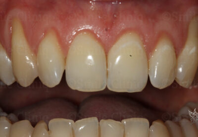 London dentist receeding gums treatment before