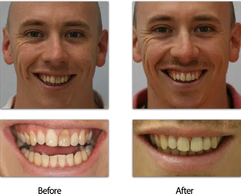 an alternative to internal tooth bleaching