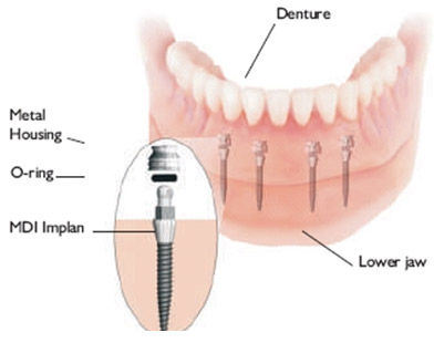 Mini Dental Implant