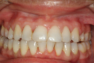 Orthodontics in London After