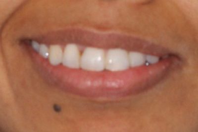 Teeth After Orthodontist Treatment