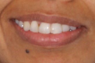 After orthodontic treatment