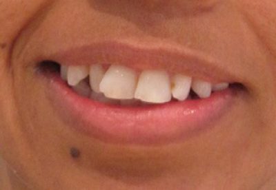 Teeth Before Orthodontist Treatment