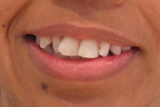 Before orthodontic treatment