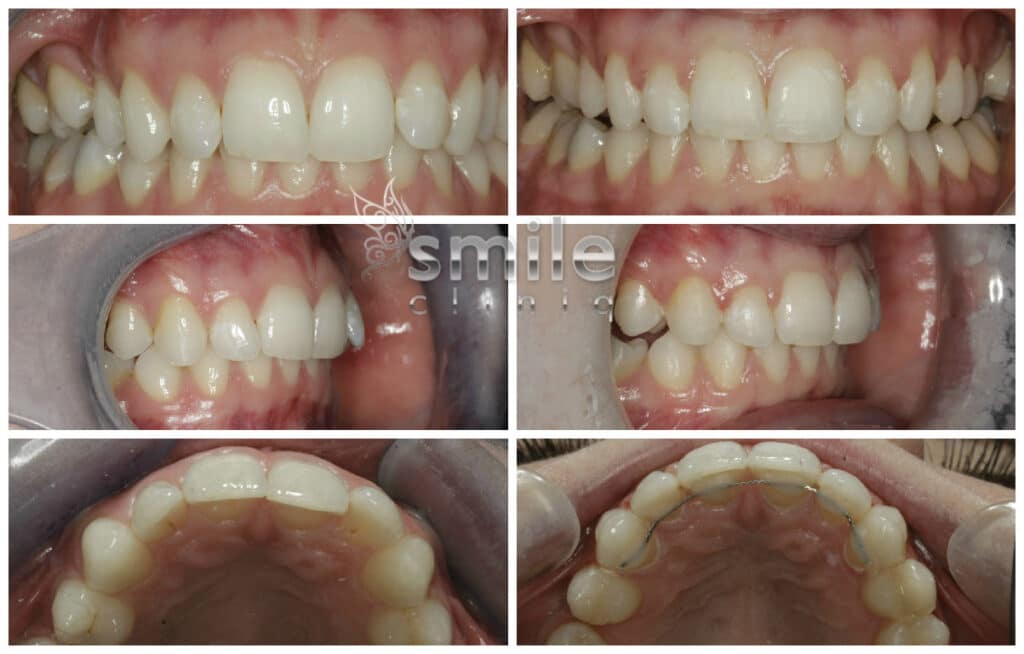 Orthodontic Treatment Views And Fixed Retainer Before And After orthodontic treatment views and fixed retainer before and after