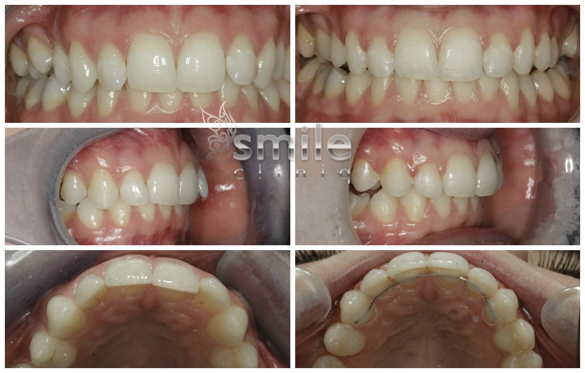 Orthodontic Treatment Views And Fixed Retainer Before And After orthodontic treatment views and fixed retainer before and after