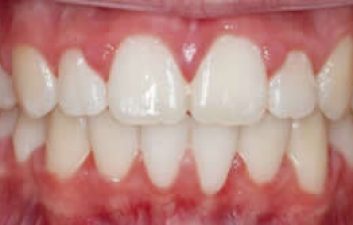 orthodontics_london_after