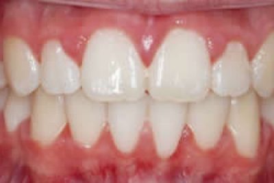 After Ceramic Braces