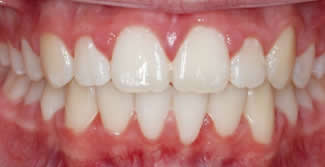 Orthodontics After