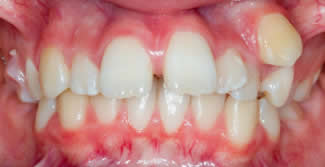 Orthodontics Before