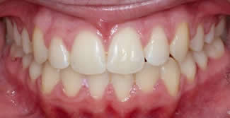 Orthodontics After