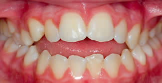 Orthodontics Before