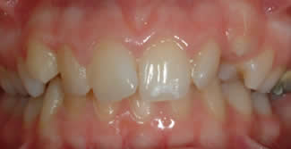 Orthodontics Before