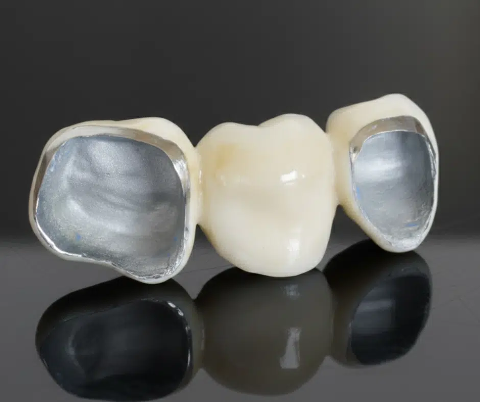 porcelain bonded bridge london