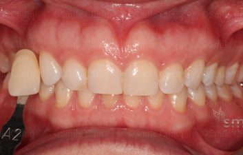 pre teeth whitening