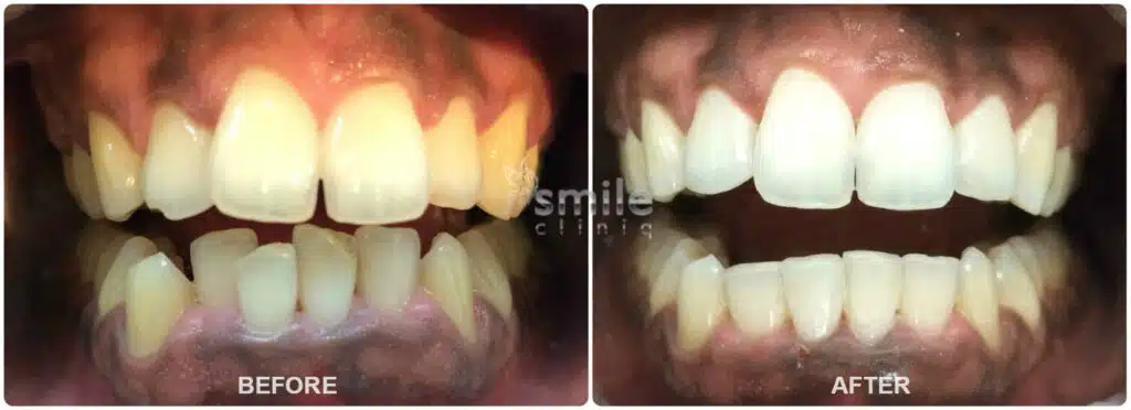Before and after: Yellow teeth whitened to bright white after dental treatment.