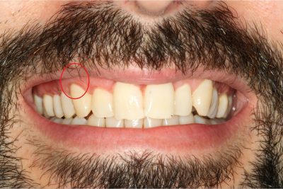 After treatment to receding gums in London