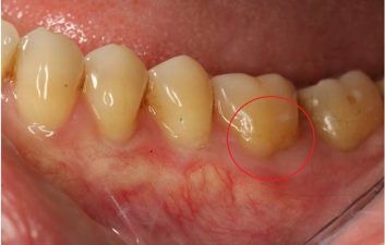 Receding gums treatment London After