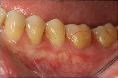 Receding Gums Treatment London After