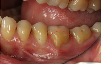 Receding gums treatment London Before