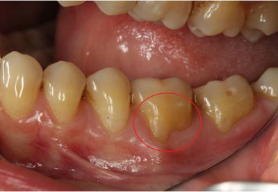 Receding Gums Treatment London Before